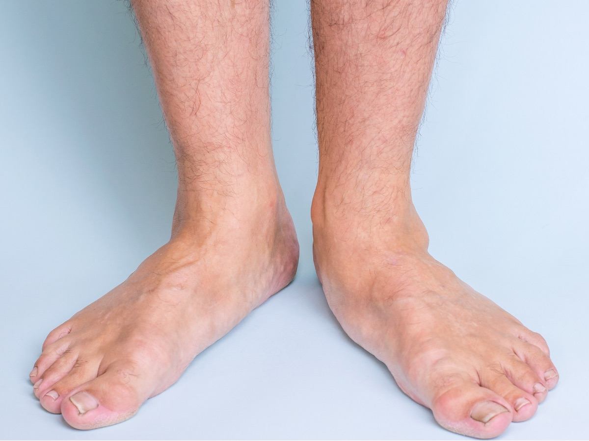 What’s the deal with flat feet?